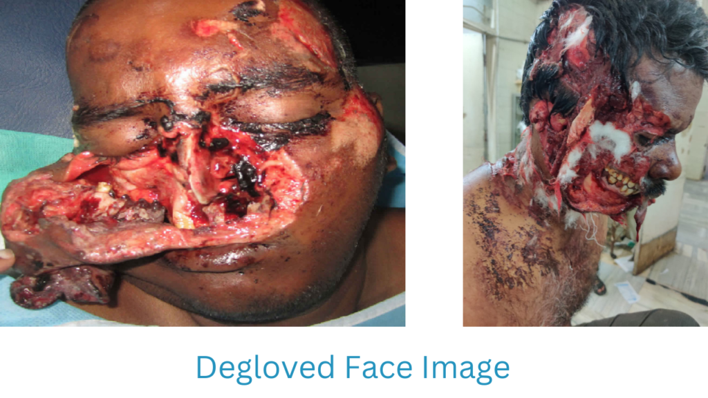 Degloved face Picture